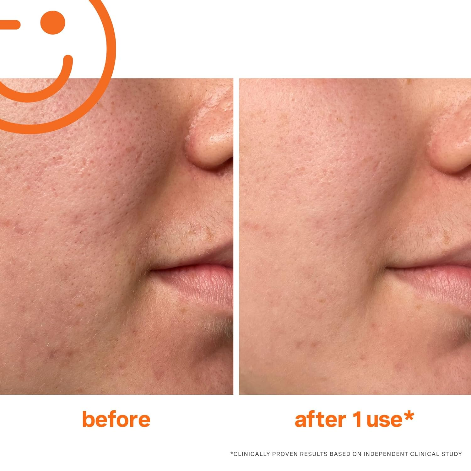 Kate Somerville ExfoliKate Intensive Exfoliating Treatment – Salicylic Acid and Lactic Acid Super Facial Scrub Improves Texture and Pores view 3